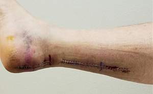 Click image for larger version. 

Name:	FRANKEN-FOOT.jpg 
Views:	270 
Size:	30.0 KB 
ID:	28862